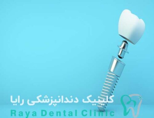 ایمپلنت اروپایی چیست و چرا در ایران محبوب شده است؟