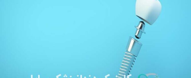 ایمپلنت اروپایی