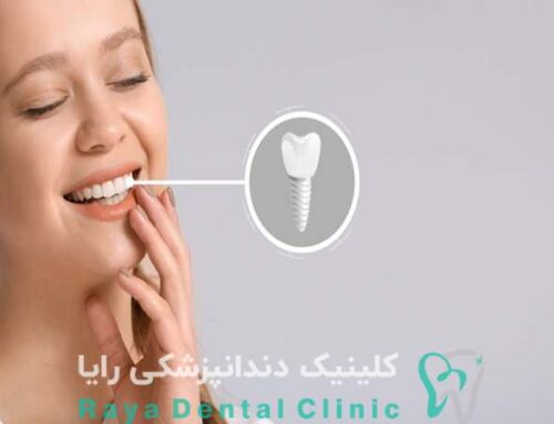 5 دلیل برای انتخاب ایمپلنت اشترومن برای دندان‌ های شما