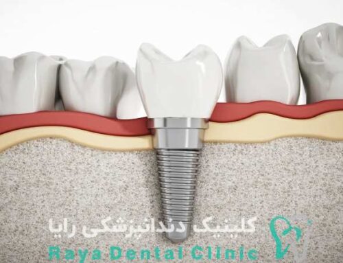 چرا ایمپلنت اشترومن انتخاب اول دندانپزشکان است؟