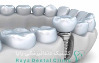 ایمپلنت‌ های اروپایی