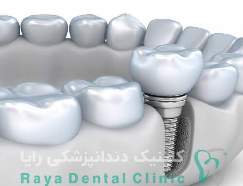 بررسی مزایای ایمپلنت‌ های اروپایی از لحاظ طراحی و کیفیت