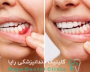 طراحی لبخند