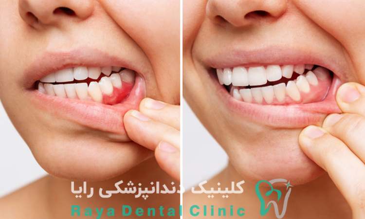 طراحی لبخند