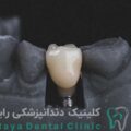 ایمپلنت سوئیسی