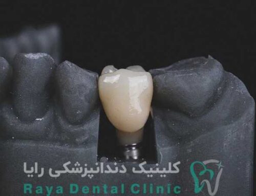 ایمپلنت سوئیسی؛ استاندارد طلایی کاشت دندان