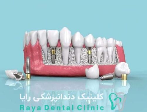ایمپلنت سوئیسی گزینه‌ ای مناسب برای جایگزینی دندان