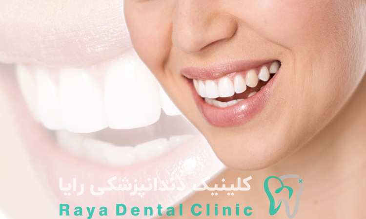 کامپوزیت رزین یا سرامیک