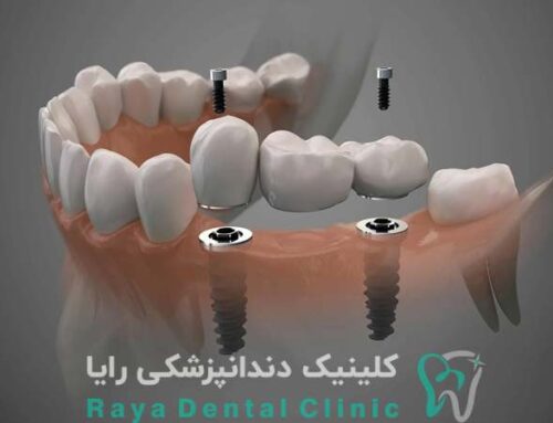 آیا بدن شما با ایمپلنت سازگار است؟ تست‌ هایی که باید بدهید!