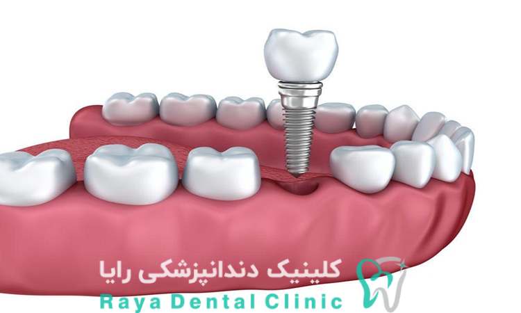 بهترین ایمپلنت اروپایی