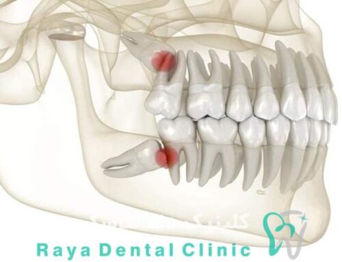 دندان عقل را جراحی کنیم یا بکشیم؟
