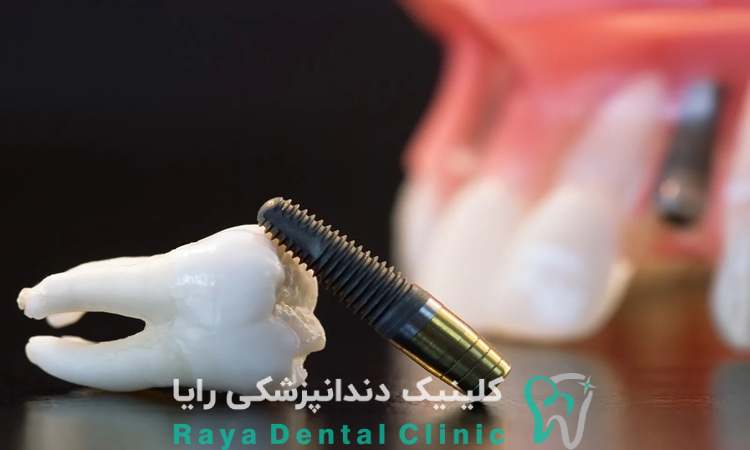 سازگاری ایمپلنت دندان