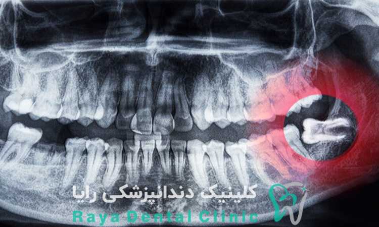 کشیدن دندان عقل