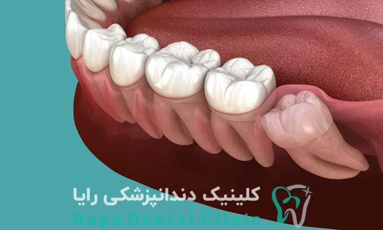 جراحی دندان عقل