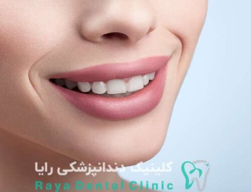 ۷ نکته طلایی قبل از انجام طراحی لبخند