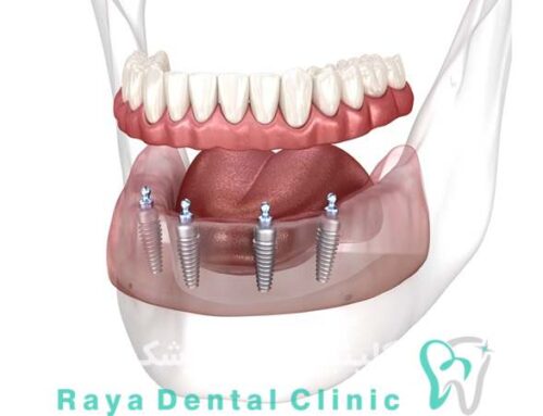 راهنمای جامع انتخاب ایمپلنت بر اساس فرم فک و استخوان شما