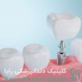 ایمپلنت دندان اروپایی