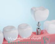 ایمپلنت دندان اروپایی