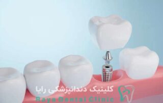ایمپلنت دندان اروپایی
