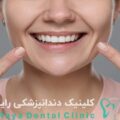 اصلاح طرح لبخند