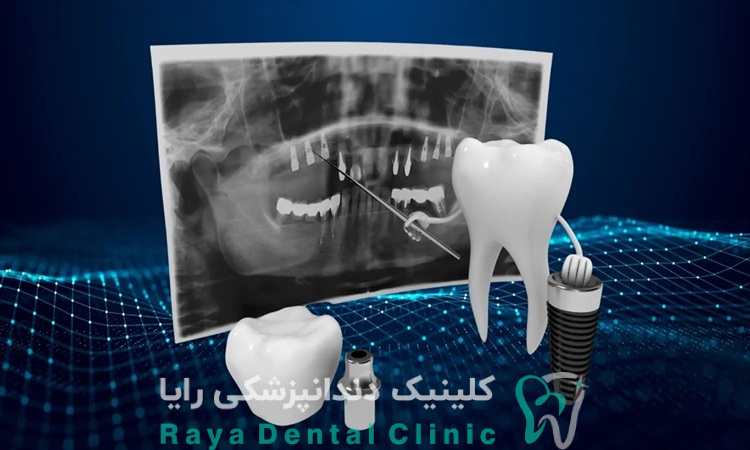 هزینه ایمپلنت دیجیتال