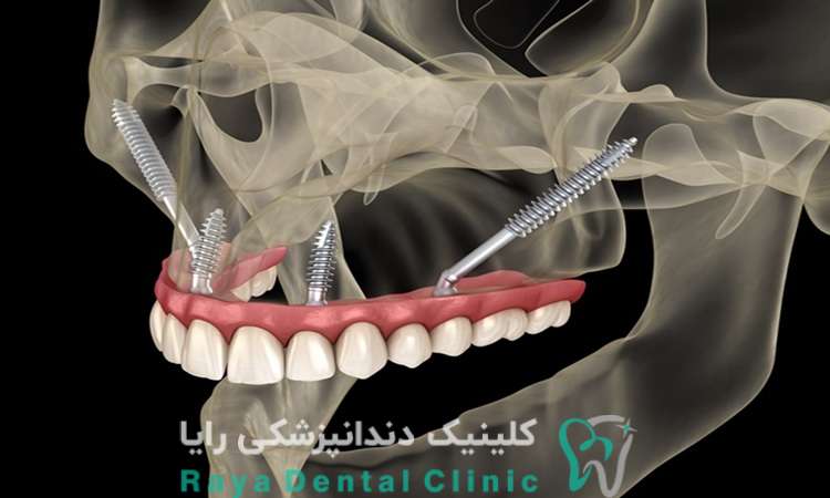هزینه ایمپلنت دیجیتال