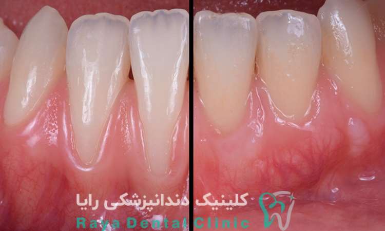 طرح لبخند