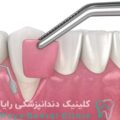 پیوند لثه