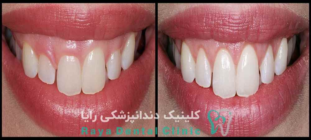 پیوند لثه چیست 