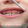 پوسیدگی دندان