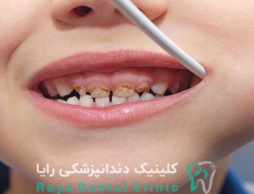 آیا درمان پوسیدگی در دندان شیری ضرورتی دارد؟