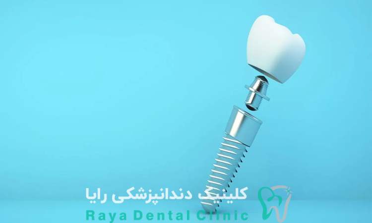 کاشت دیجیتال ایمپلنت