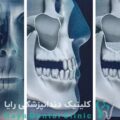جراحی سینوس لیفت