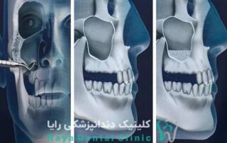 جراحی سینوس لیفت