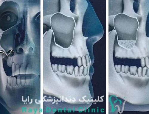 چه زمانی جراحی سینوس لیفت واجب است؟