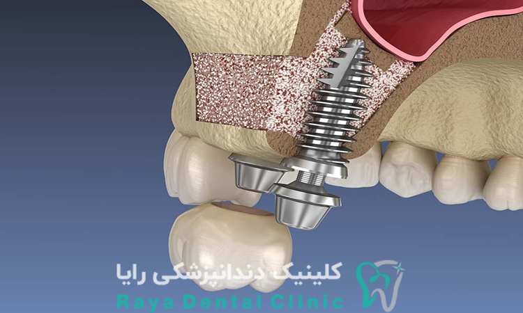 مراحل جراحی سینوس لیفت