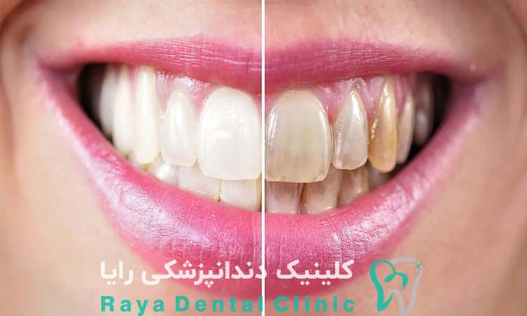 اصلاح لبخند در سالمندان
