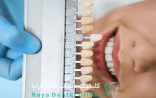 ونیر دندان