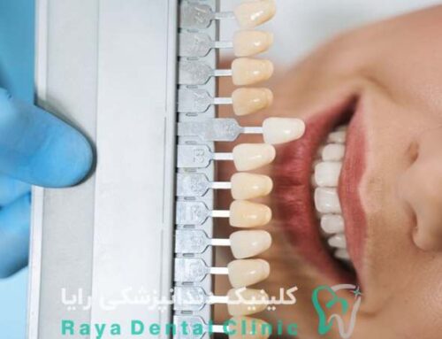 چرا ونیرها دیگر اولین انتخاب برای زیبایی دندان نیستند؟