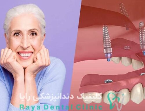 راهنمای جامع هزینه ایمپلنت دندان برای بیماران بالای ۴۰ سال