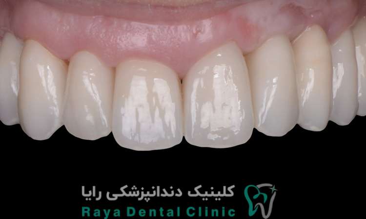 کامپوزیت باکیفیت