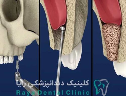 جراحی افزایش ارتفاع استخوان فک برای ایمپلنت