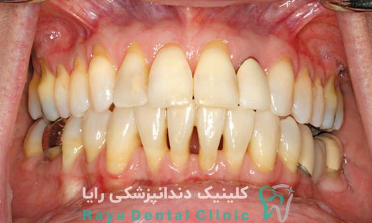 تحلیل لثه چیست؟
