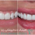 لمینیت دندان