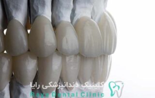 ترندهای کامپوزیت دندان