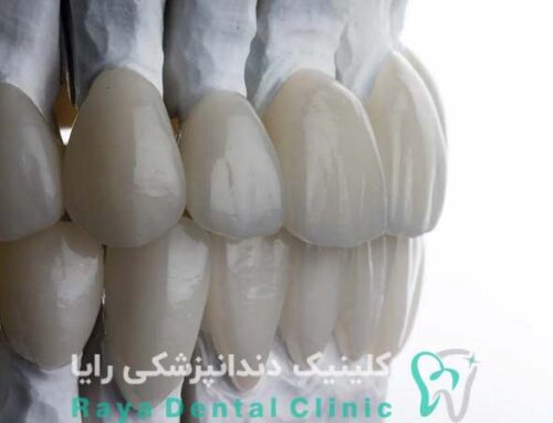 جدیدترین ترندهای کامپوزیت دندان در سال ۱۴۰۴