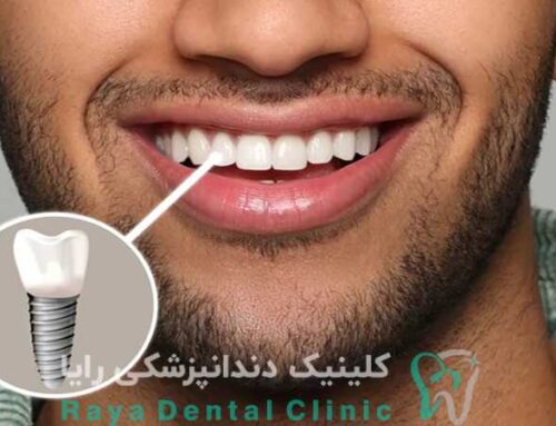 تاثیر طراحی لبخند در انتخاب روش ایمپلنت دیجیتال