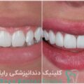 قیمت لمینیت دندان