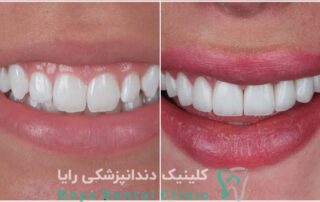 قیمت لمینیت دندان