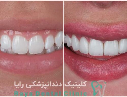چرا قیمت لمینیت دندان در کلینیک‌ های مختلف تفاوت دارد؟